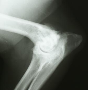Xray of arthritis in an elbow joint