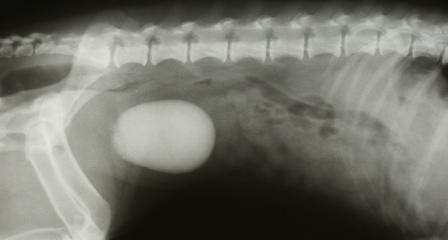 Bladder stone