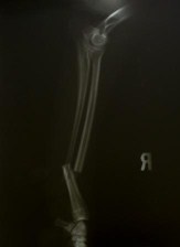Jackson's fractured leg