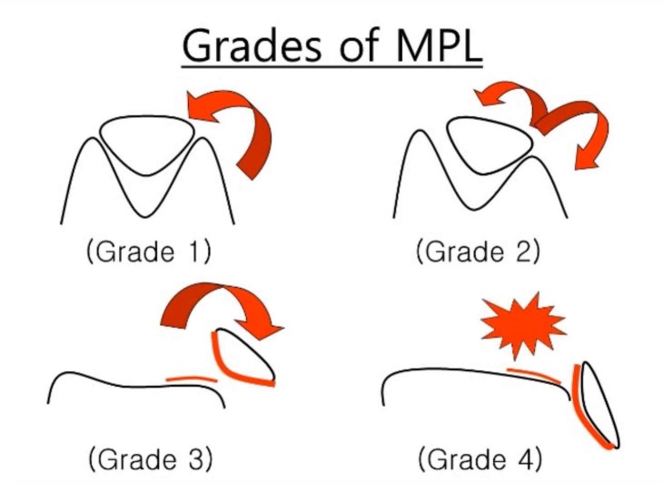 Grades of medial patella luxation