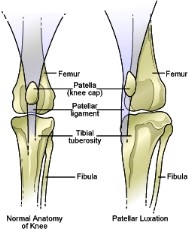 patella luxation